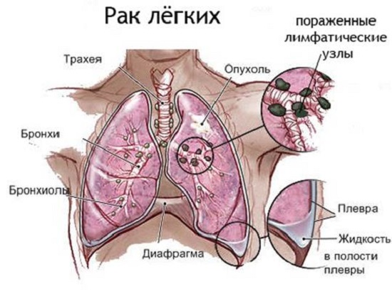 Основные признаки рака легких на ранней стадии у женщин, которые нельзя игнорировать!