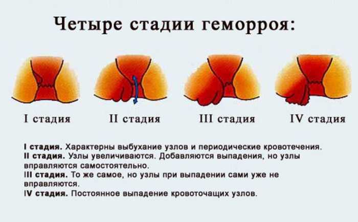 Она больше не боится ГЕМОРРОЯ! Смотри, 10 самых эффективных средств от свай.