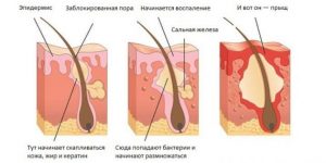 Причины появления прыщей на спине и способы избавления от них в домашних условиях