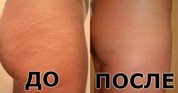 Масло от растяжек и обвисшей кожи