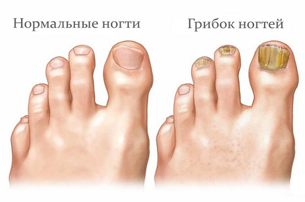 Дешевые средства, которые помогут избавиться от грибка ногтей Дешевые средства, которые помогут избавиться от грибка ногтей