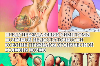 23 признаков болезни почек, о которых вы не знали!