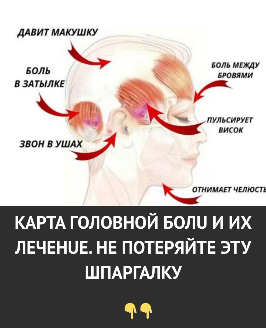 Карта головной боли и способы её лечения. Не потеряйте эту полезную шпаргалку