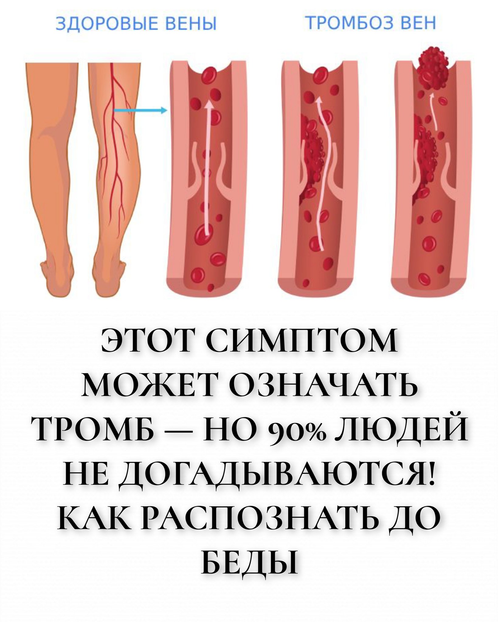 Этот симптом может означать тромб — но 90% людей не догадываются! Как распознать до беды Этот симптом может означать тромб — но 90% людей не догадываются! Как распознать до беды