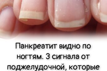 Панкреатит видно по ногтям. 3 сигнала от поджелудочной, которые не стоит игнорировать после 55 лет