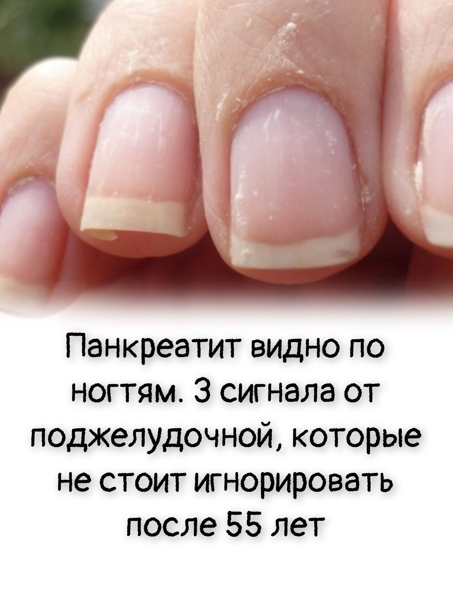 Панкреатит видно по ногтям. 3 сигнала от поджелудочной, которые не стоит игнорировать после 55 лет Панкреатит видно по ногтям. 3 сигнала от поджелудочной, которые не стоит игнорировать после 55 лет