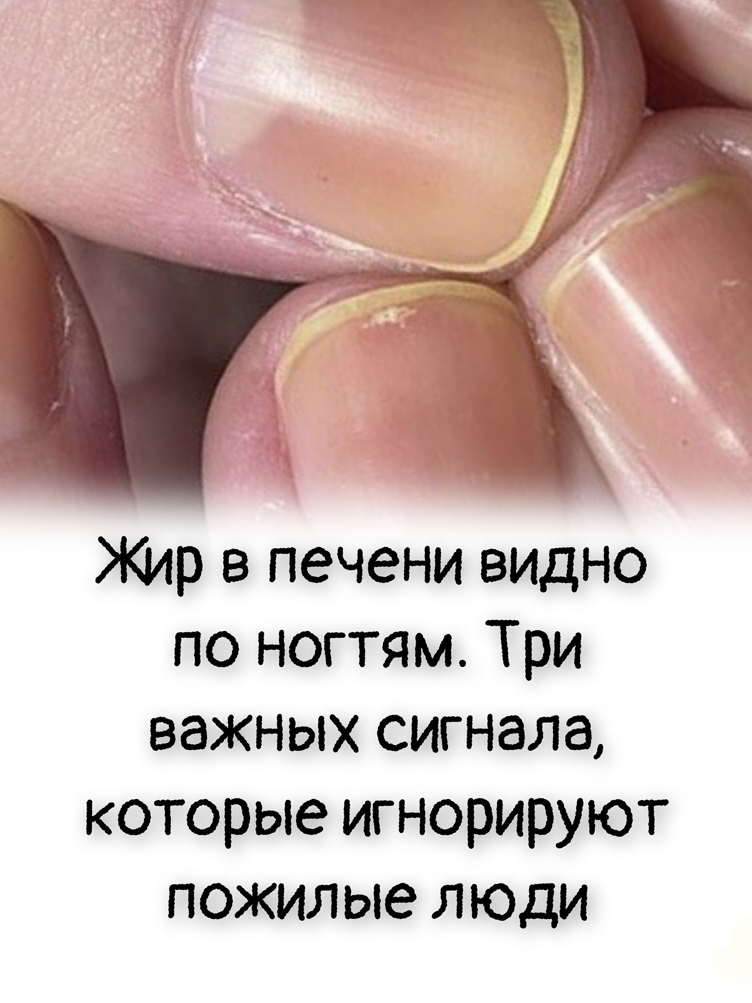Жир в печени видно по ногтям. Три важных сигнала, которые игнорируют пожилые люди