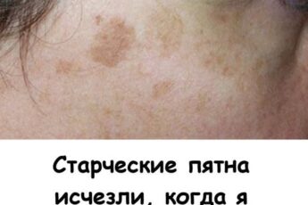 Старческие пятна ИСЧЕЗЛИ, когда я добавила в рацион эти 4 простых продукта.